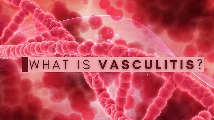 https://flairinsights.com/report-description/global-vasculitis-treatment-market-growth-and-forecast