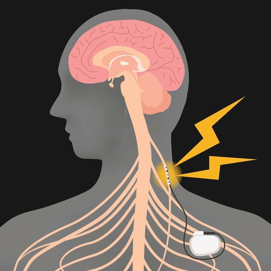 Vagus Nerve Stimulation